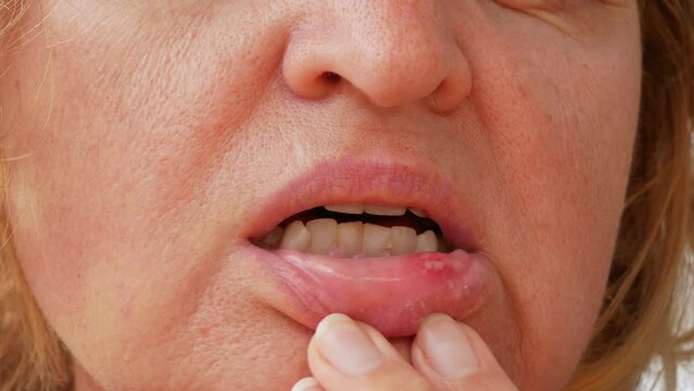 stomatitis in mouth closeup, close-up on the lip with aphthous stomatitis, treatment of inflammation of the oral mucosa, concept
