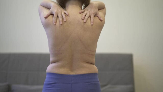 Woman with irritated skin under bra, irritation on the body from underwear, pain in shoulders, body care concept