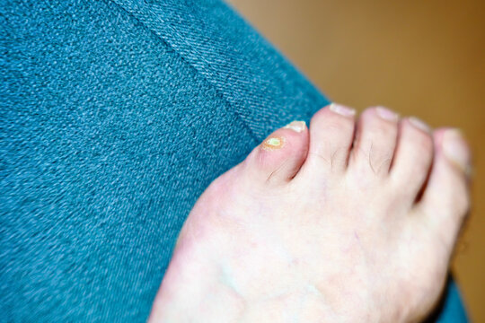 Old dry callus on the little toe