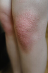 Allergic reaction on the skin of the knees. Reaction to nettle. Treatment of pain with folk methods. Vertical photo.