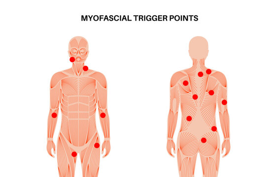 Myofascial trigger points