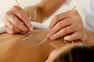 Photo of an acupuncture therapist restoring energy balance in a patient's body through focused treatment - obrazy, fototapety, plakaty