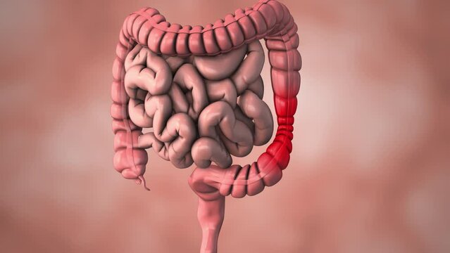 An intestinal disorder causing pain in the stomach