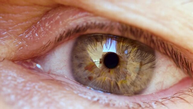 Red eye, irritated sclera, dry eye blink in pretty green iris, slow motion 60 fps