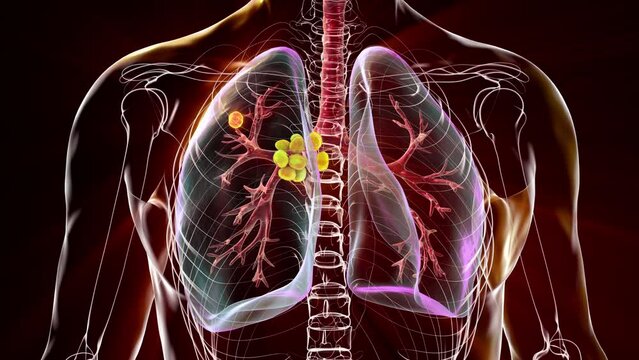 Primary lung tuberculosis, animation