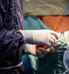 neurosurgeon , doing surgery, operation theater, subdural hematoma in the brain, multiple...