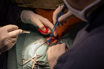 neurosurgeon , doing surgery, operation theater, subdural hematoma in the brain, multiple...