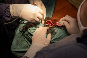 neurosurgeon , doing surgery, operation theater, subdural hematoma in the brain, multiple...