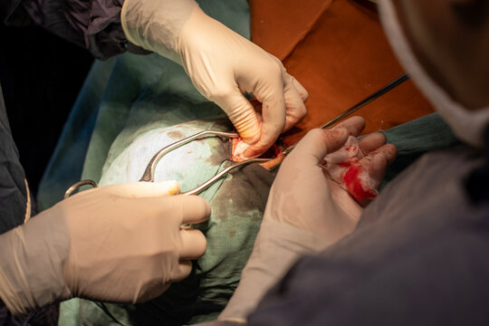 neurosurgeon , doing surgery, operation theater, subdural hematoma in the brain, multiple neurosurgeon, open brain surgery.