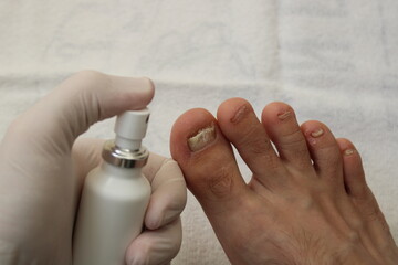 dermatologist examining patient with toenail fungus. A doctor examines bare foot with onycholysis...