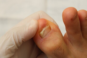 dermatologist examining patient with toenail fungus. A doctor examines bare foot with onycholysis...