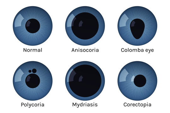 Eye pupils set with disease vector illustration.