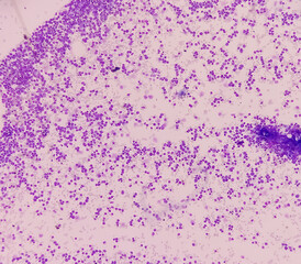 Blood cancer. Photomicrograph of Acute Myeloblastic Leukemia or AML, a cancer of white blood cell. Bone marrow study. Microscopic of BMS smear.