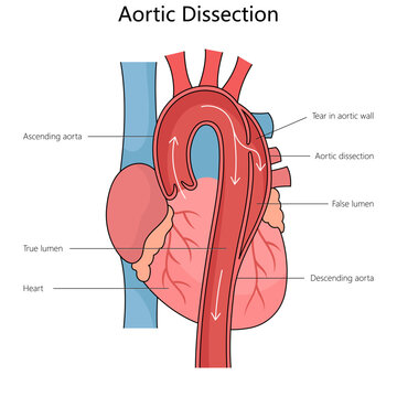 Human aortic dissection, showing the true and false lumens and a tear in the aortic wall structure diagram hand drawn schematic vector illustration. Medical science educational illustration