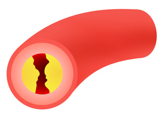 Cholesterol blocked artery illustration. Clogged arteries caused by cholesterol.