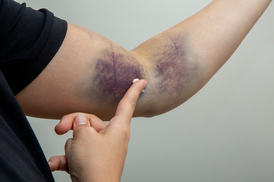 Rubbing ointment onto a bruise using a fingertip.