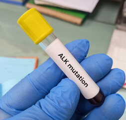 Blood sample for ALK (Anaplastic Lymphoma Kinase) gene test, ALK mutation analysis.