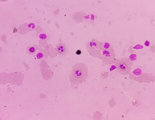 Bone marrow study, microscopically show megakaryocytes. Megakaryocytic hyperplasia....