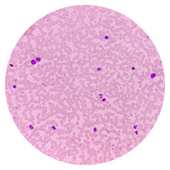 Bone marrow study, microscopically show megakaryocytes. Megakaryocytic hyperplasia. Thrombocytopenia.