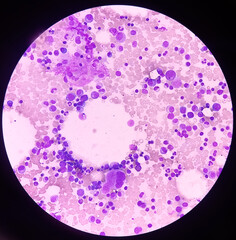 Bone marrow study, microscopically show megakaryocytes. Megakaryocytic hyperplasia....