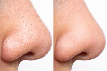 Close-up before and after a young woman's face with sweat and oily shine on her nose. Large...
