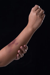 Bruises from blood on woman arm. Injection bruises.