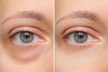 Close-up of the face of a young woman with a bag under her eye before and after treatment. Swelling of the lower eyelid. Removing bruises and dark circles using cosmetics and creams. Blepharoplasty - obrazy, fototapety, plakaty