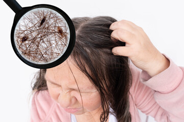woman scratching head, close-up hair lice, feeling itchy and possibly having lice, showing effects...