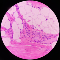Microscopic image of above knee amputation. Section show fibro collagenous tissue, fatty tissue, skeletal muscles with inflammatory cells. Bony soft tissue resection margin. Bone cancer.