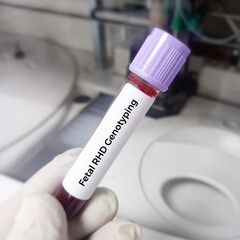 Blood sample for Fetal RHD Screening test for pregnant women. Down syndrome. Disorder of the...