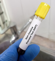 Blood sample for Fetal RHD Screening test for pregnant women. Down syndrome. Disorder of the...