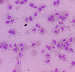 Leukemia. Photomicrograph of hematological blood slide showing neutrophilic leukocytosis with...