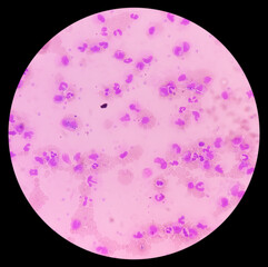 Leukemia. Photomicrograph of hematological blood slide showing neutrophilic leukocytosis with monocytosis with occasional myelocytes seen. Chronic myelomonocytic leukemia. Thrombocytopenia.