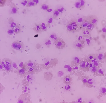 Leukemia. Photomicrograph of hematological blood slide showing neutrophilic leukocytosis with monocytosis with occasional myelocytes seen. Chronic myelomonocytic leukemia. Thrombocytopenia.