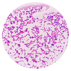CT Guaided FNA cytology from sacral lytic lesion. Microscopic show atypical plasmacytoid cells,...