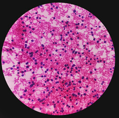 CT Guaided FNA cytology from sacral lytic lesion. Microscopic show atypical plasmacytoid cells,...