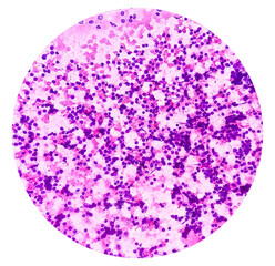 CT Guaided FNA cytology from sacral lytic lesion. Microscopic show atypical plasmacytoid cells, background show lymphocytes, histiocytes and blood. Malignant cell and Plasmacytoma.