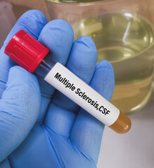 CSF sample for Multiple Sclerosis testing. Multiple Sclerosis disease test medical laboratory.