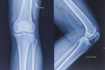 Knee joint x-ray ap and lateral view, Early degenerative osteoarthritis. - obrazy, fototapety, plakaty