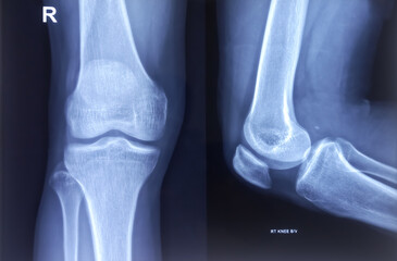 Knee joint x-ray ap and lateral view, normal skeletal. normal findings.