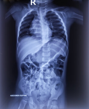 X-ray of Abdumen. Large bowel loops are distended with gas and loaded with faecal matters.