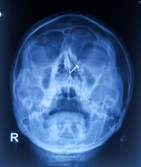 PNS X-ray OM view film, bilateral maxillary sinusitis with hypertrophied inferior turbinates. show...