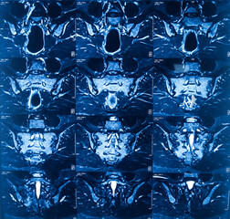 MRI (magnetic resonance imaging) of Lumbo sacral Spine. Degenerative change in lumber spine....