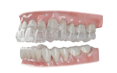Dental orthodontic clear aligner
