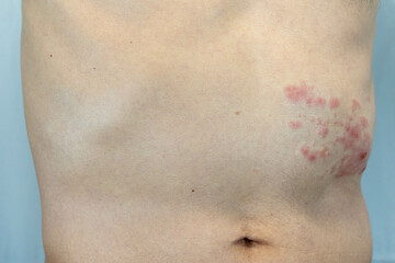 胴体の左側に帯状疱疹を発症した男性の画像

