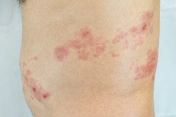 胴体の左側に帯状疱疹を発症した男性の画像
