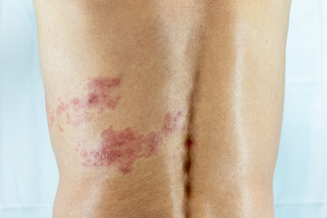 胴体の左側に帯状疱疹を発症した男性の画像
