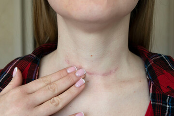 scar after surgery on woman neck