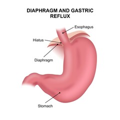 Stomach diaphragm and gastric reflux illustration - obrazy, fototapety, plakaty