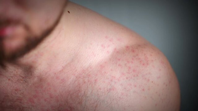 Common skin problems of human body, red spots on shoulder being acne rashes, unhygienic lifestyle, fat food, alcohol, hormones and stress leading to skin rashes and different unpleasant allergies
